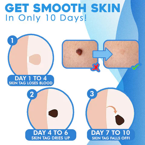 Skin Tag Removal Kit with Banding Tool for Warts and Moles