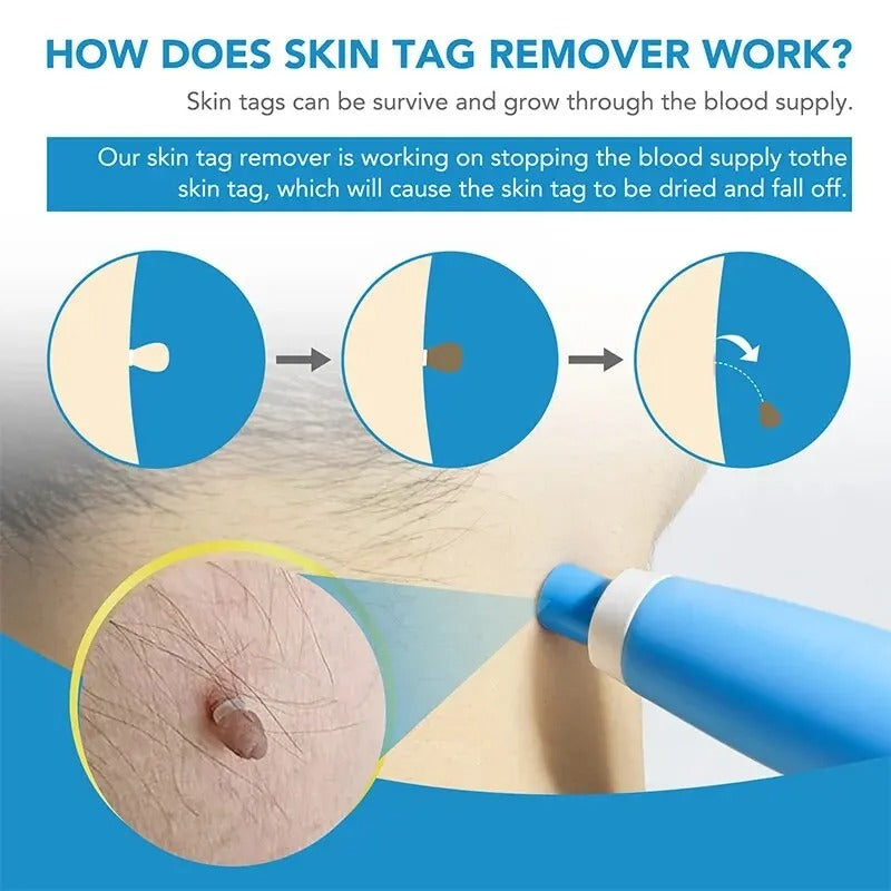 At-Home Skin Tag Removal Kit with Ligation Bands