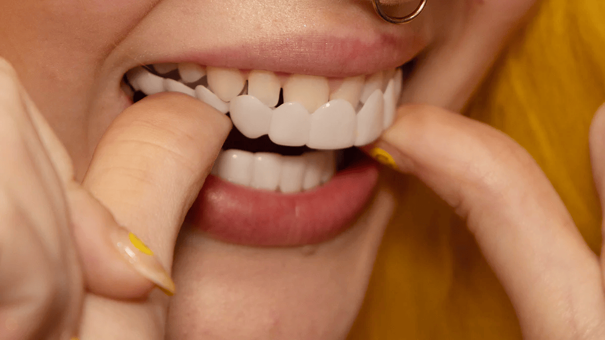 Snap-On Upper and Lower Teeth Veneers for a Natural Smile