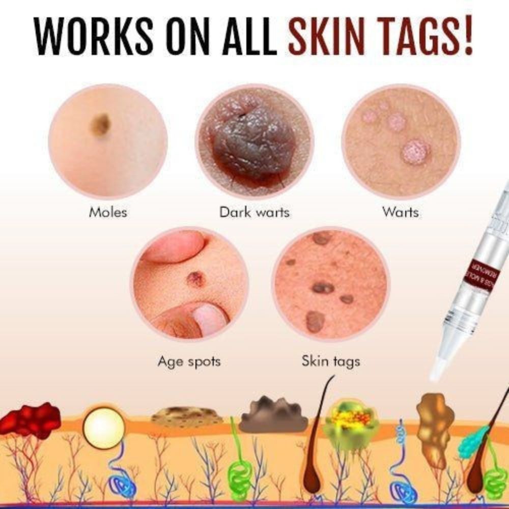 Skin Tag and Mole Remover with Tea Tree Oil