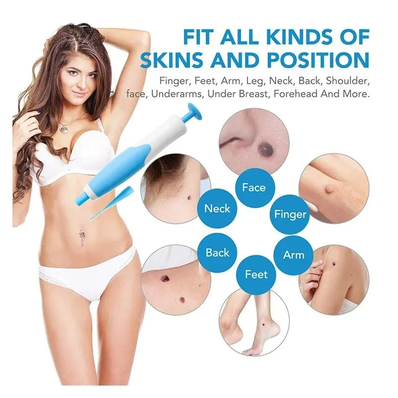 At-Home Skin Tag Removal Kit with Ligation Bands