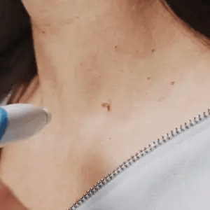 Skin Tag Removal Kit with Banding Tool for Warts and Moles