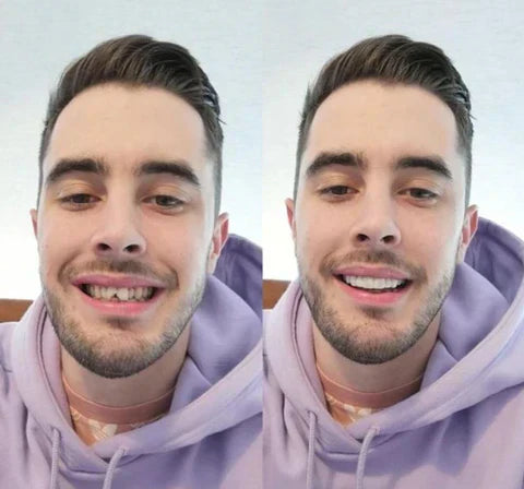 Snap-On Upper and Lower Teeth Veneers for a Natural Smile