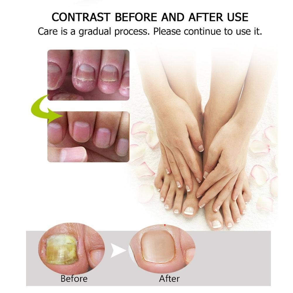 Moisturizing Gel for Weak and Discolored Nails