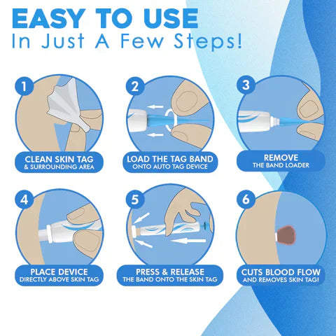 Skin Tag Removal Kit with Banding Tool for Warts and Moles