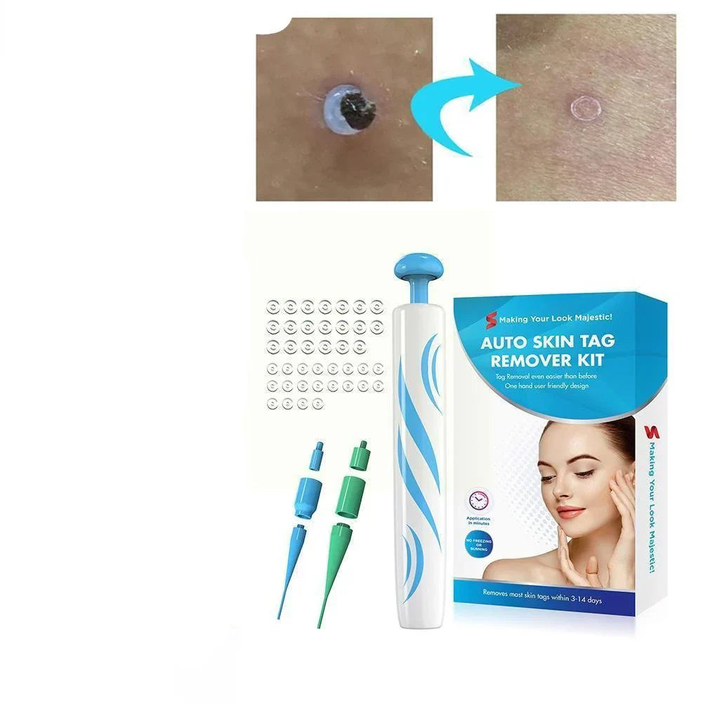 Painless Auto Skin Tag Remover Kit