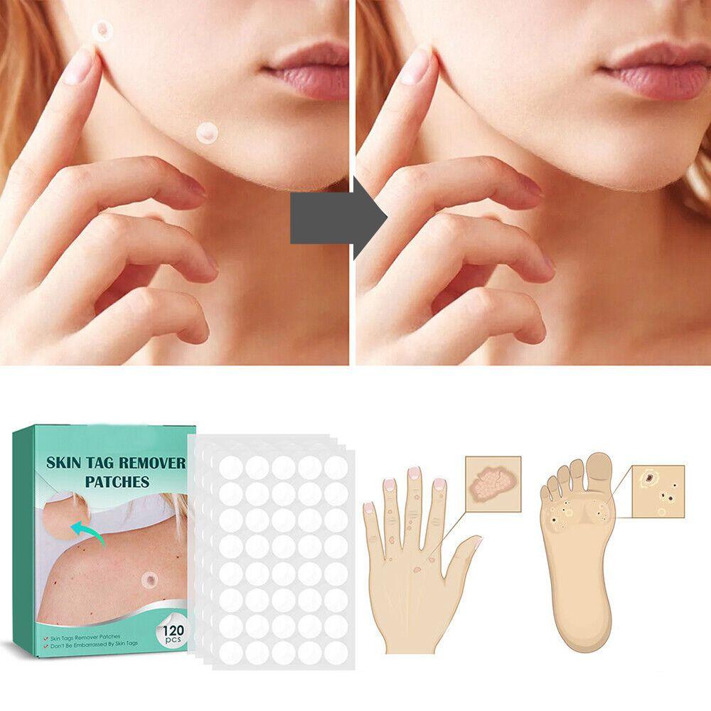 Painless Wart Remover for All Skin Types
