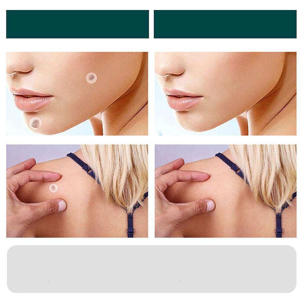 Painless Wart Remover for All Skin Types