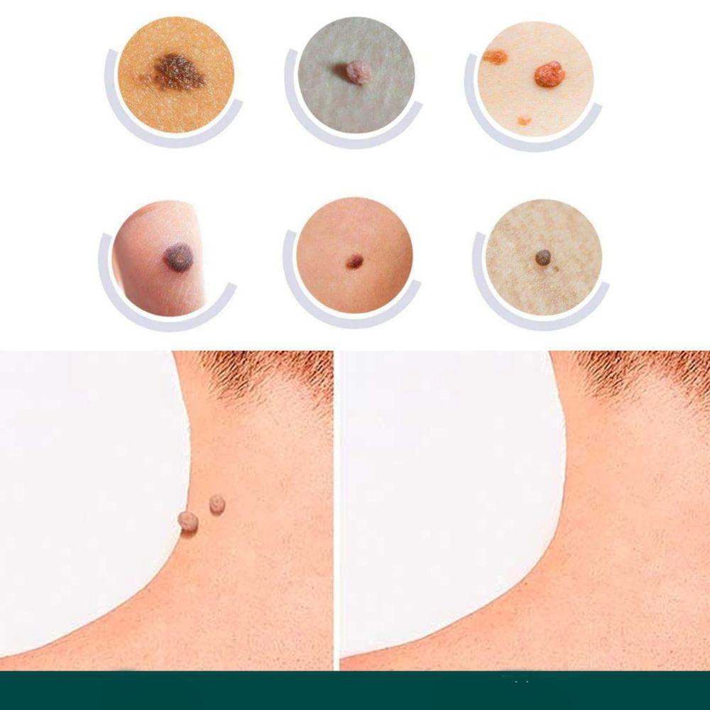 Painless Wart Remover for All Skin Types