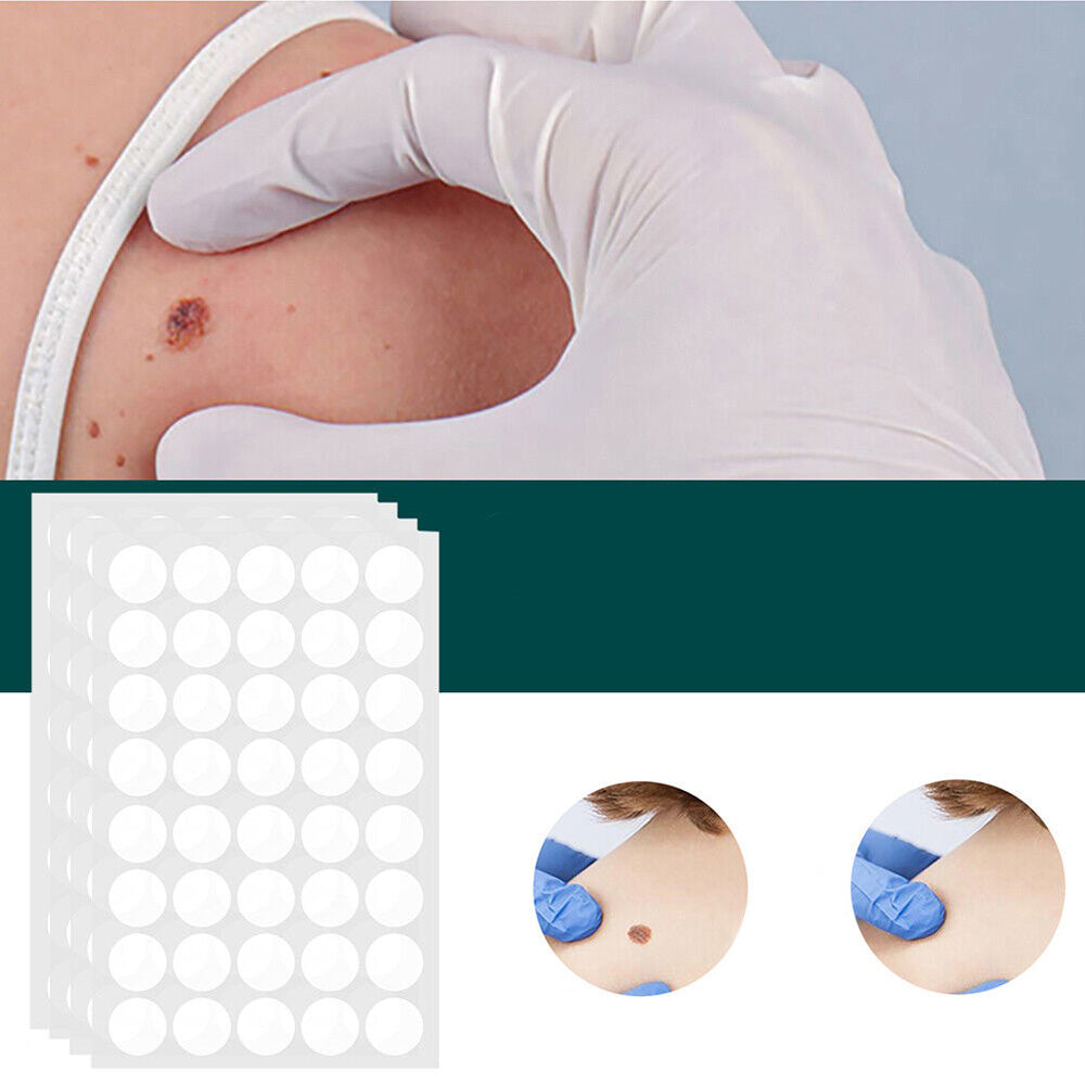 Painless Wart Remover for All Skin Types