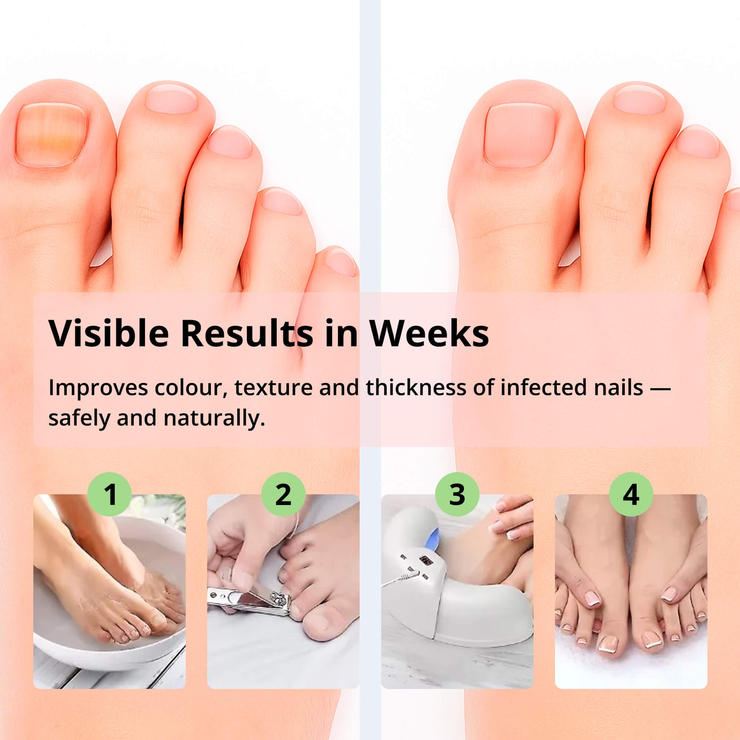 Light Therapy Nail Treatment Device for Healthy, Beautiful Nails