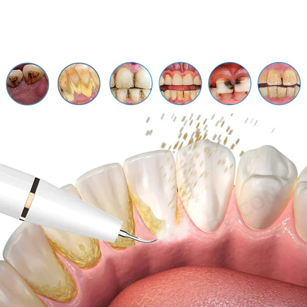 Ultrasonic Dental Cleaning Tool for Sensitive Gums