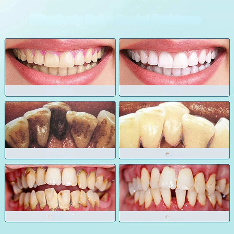 Ultrasonic Dental Cleaning Tool for Sensitive Gums