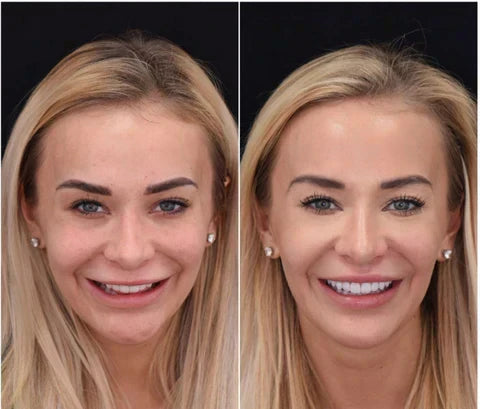Snap-On Upper and Lower Teeth Veneers for a Natural Smile