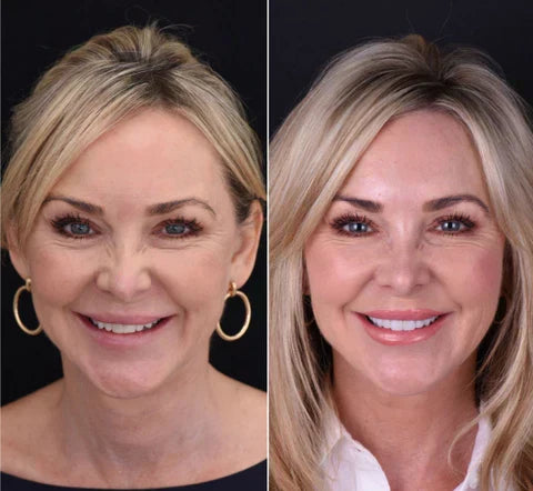 Snap-On Upper and Lower Teeth Veneers for a Natural Smile