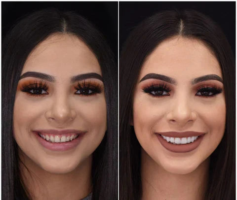 Snap-On Upper and Lower Teeth Veneers for a Natural Smile