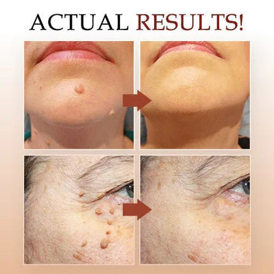 Skin Tag and Mole Remover with Tea Tree Oil