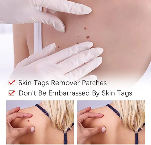 Skin Tag and Mole Remover with Tea Tree Oil