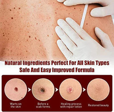 Skin Tag and Mole Remover with Tea Tree Oil