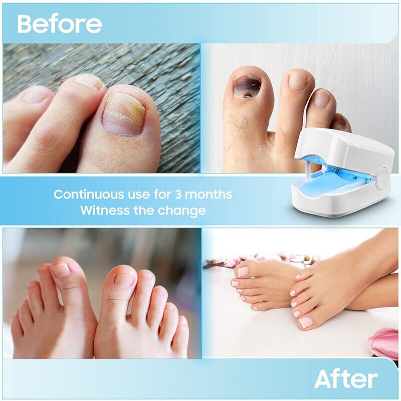 Pain-Free Laser Treatment Device for Nail Fungus