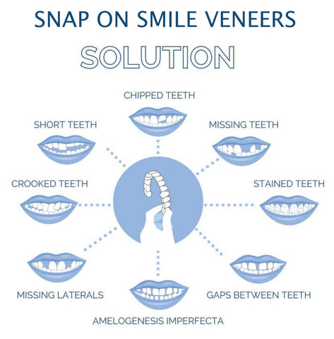 Clip-On Dental Veneers for Crooked or Stained Teeth - Comfortable & Natural Look