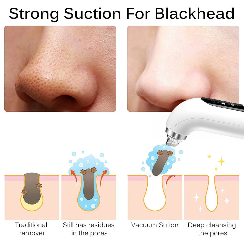Electric Blackhead Remover Vacuum with Blue Light Technology