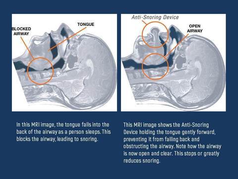 Tongue Stabilizing Anti-Snore Device