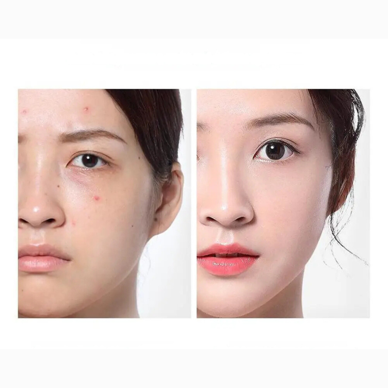 Acne Toner for Sensitive Skin with Deep Hydration and Clarity
