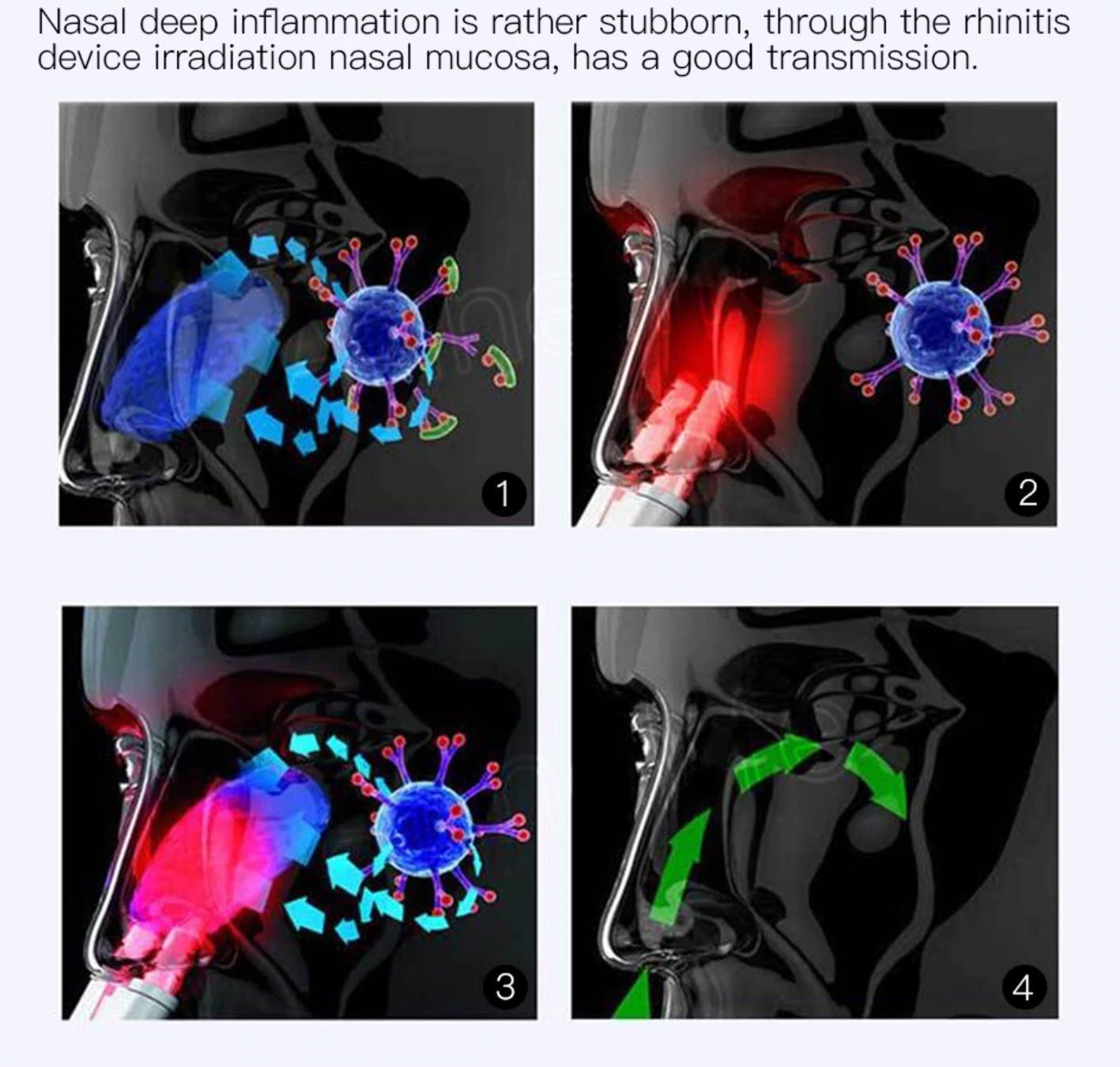 Nasal Comfort Therapy Device for Rhinitis and Allergies