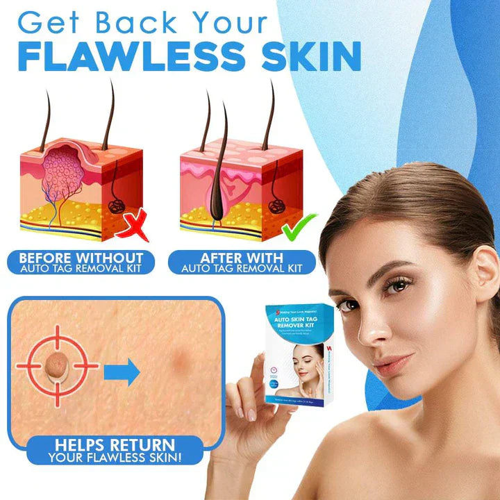 Pain-Free Skin Tag and Wart Removal Set