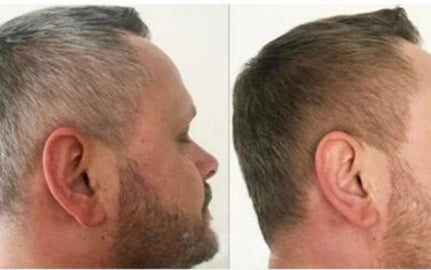 Hair Restoration Serum for Gray Hair - Gradual Natural Color Recovery